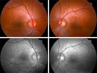 Inner Retinal Dysfunction in the Autosomal Recessive Spastic Ataxia of Charlevoix-Saguenay